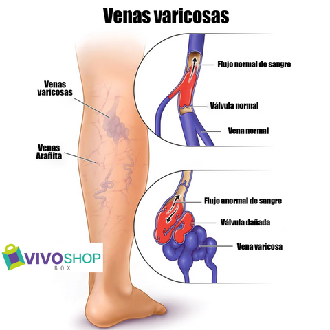 Image of VARIVENI-PATCH™ - VENAS VARICOSAS Y ARAÑITAS